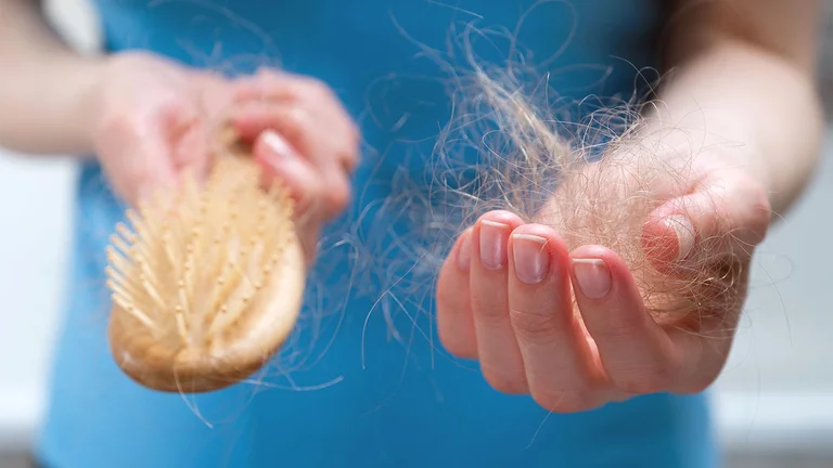 Alopecia areata: quiénes se pueden beneficiar con el nuevo medicamento