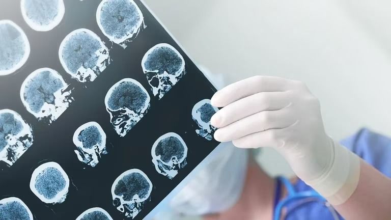 Alzheimer: estudian si un joven de 19 años es el caso más temprano de la enfermedad